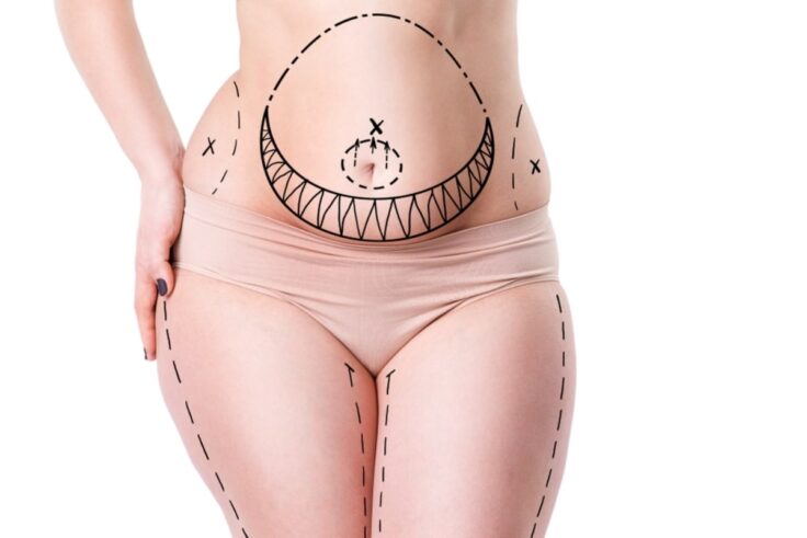 6 Things To Know If You're Considering Liposuction