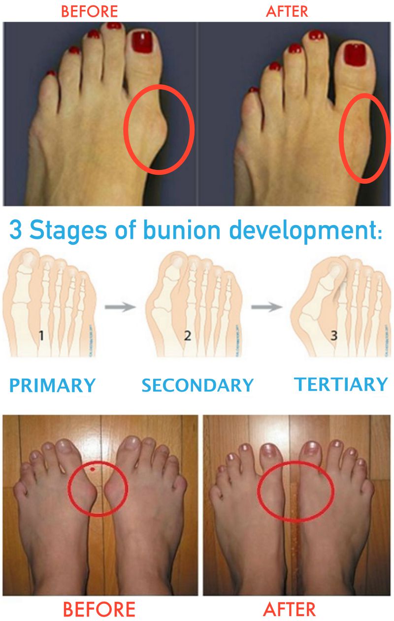 How to treat bunions