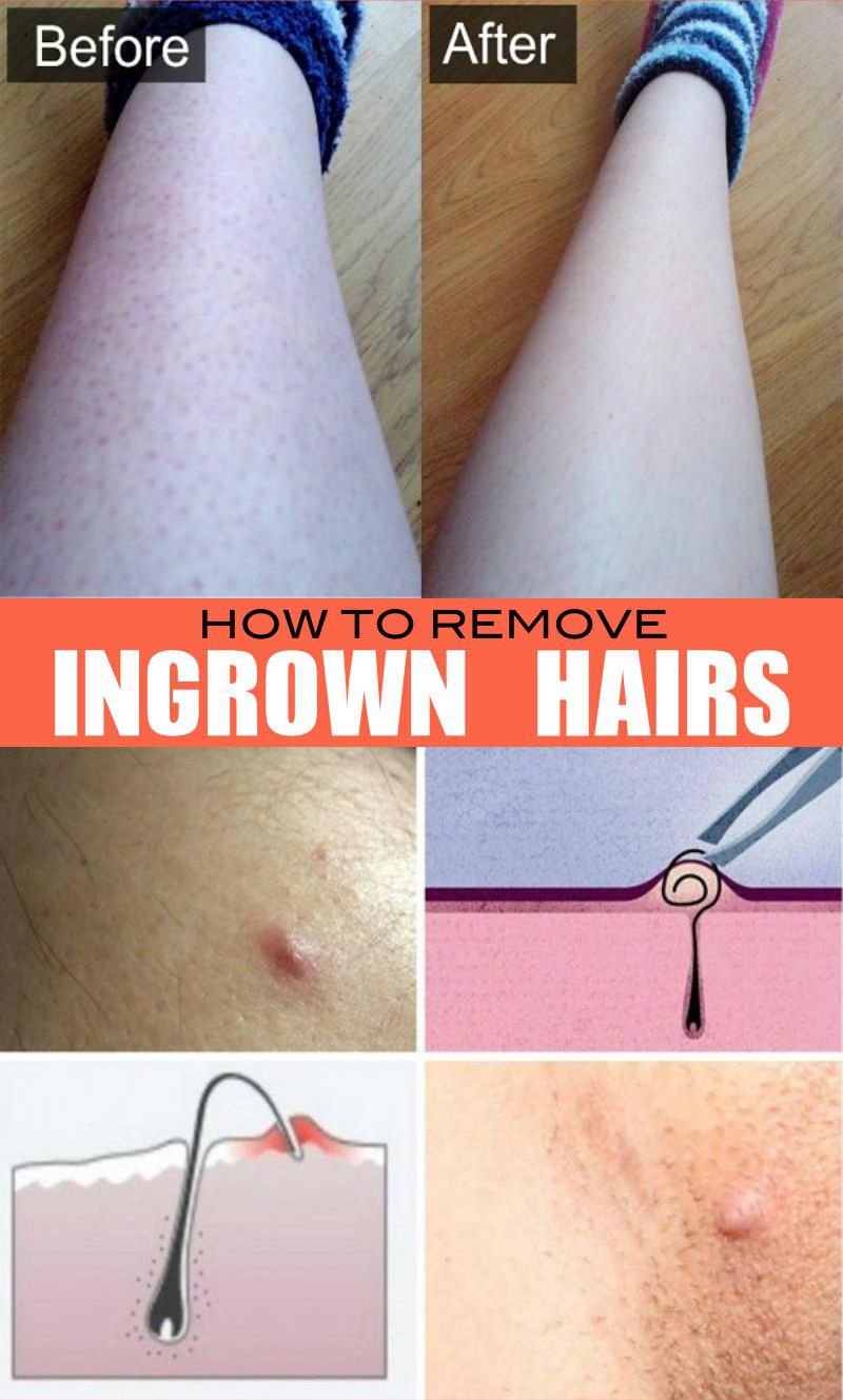 How To Remove Ingrown Hairs From Under The Skin