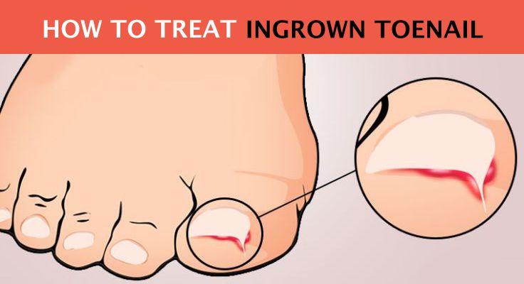 How To Treat Ingrown Toenail