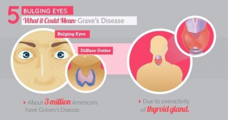 Eyes and Grave's Disease