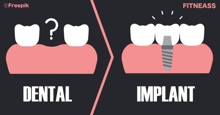 A Comprehensive And Helpful Dental Implants Guide