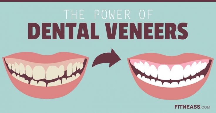 The Power Of Dental Veneers