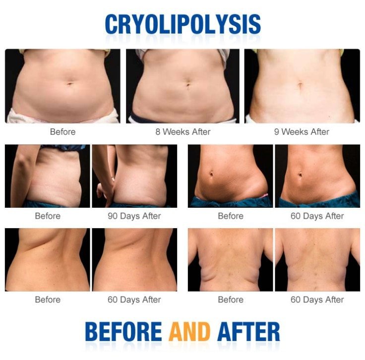 Cryolipolysis To Spot Reduce Fat