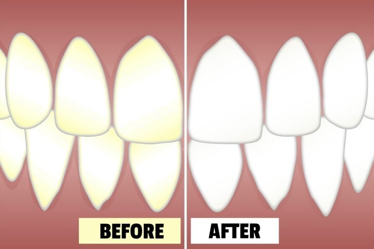 8 Teeth Bleaching Methods To Whiten Your Teeth At Home Fitneass