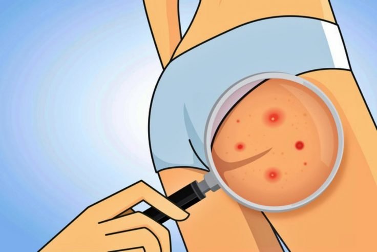 Natural Home Remedies To Treat Boils On The Buttocks