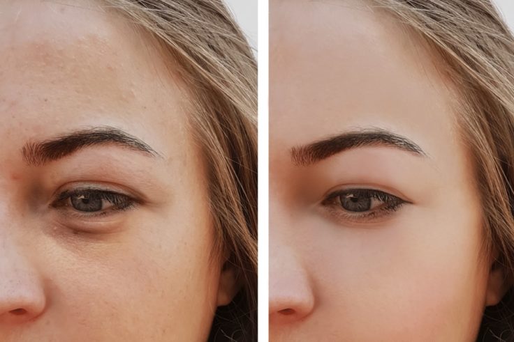 How To Remove Dark Circles Under Eyes Permanently
