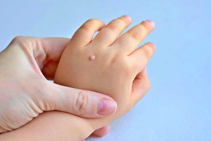 10 Best Ways To Get Rid Of Warts For Good